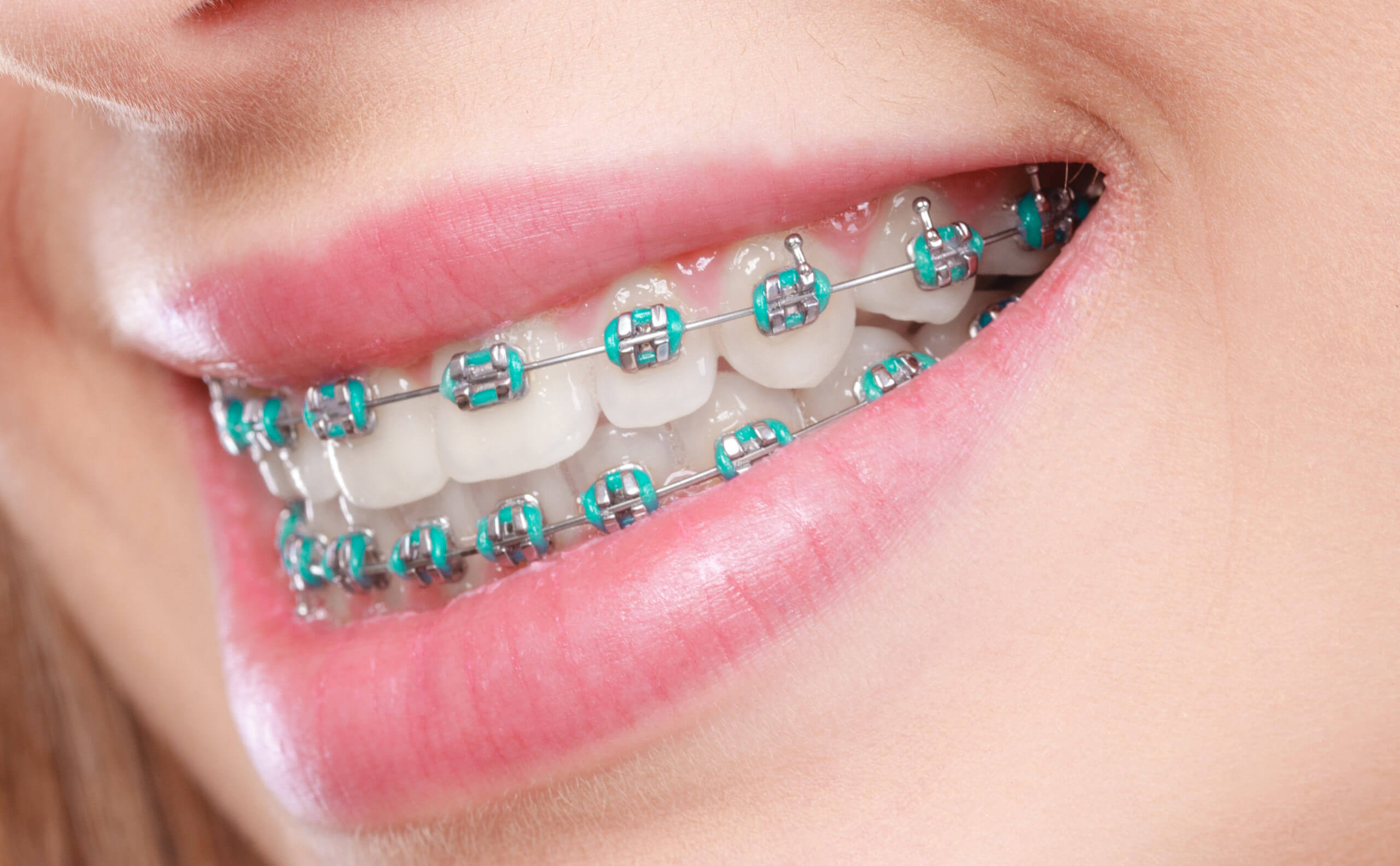 Braces & Orthodontics