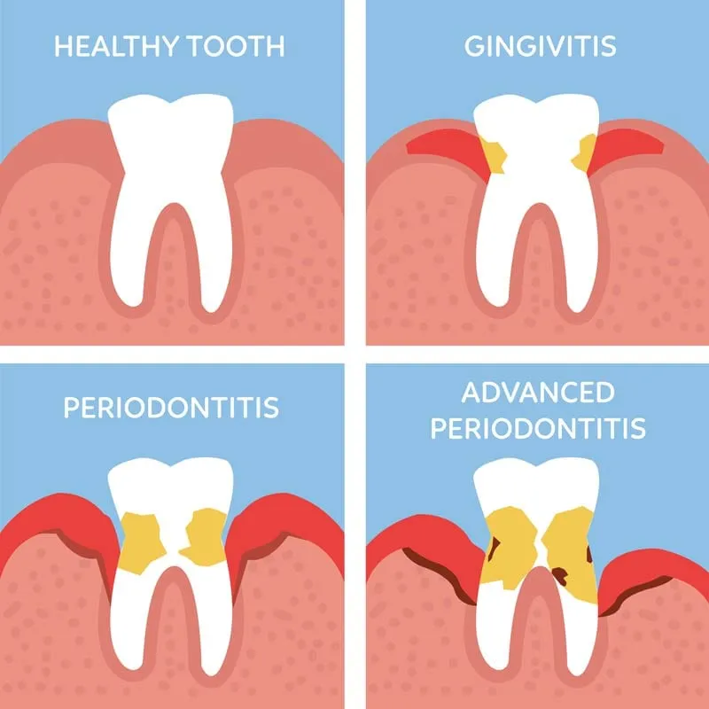 Gum Disease Treatment