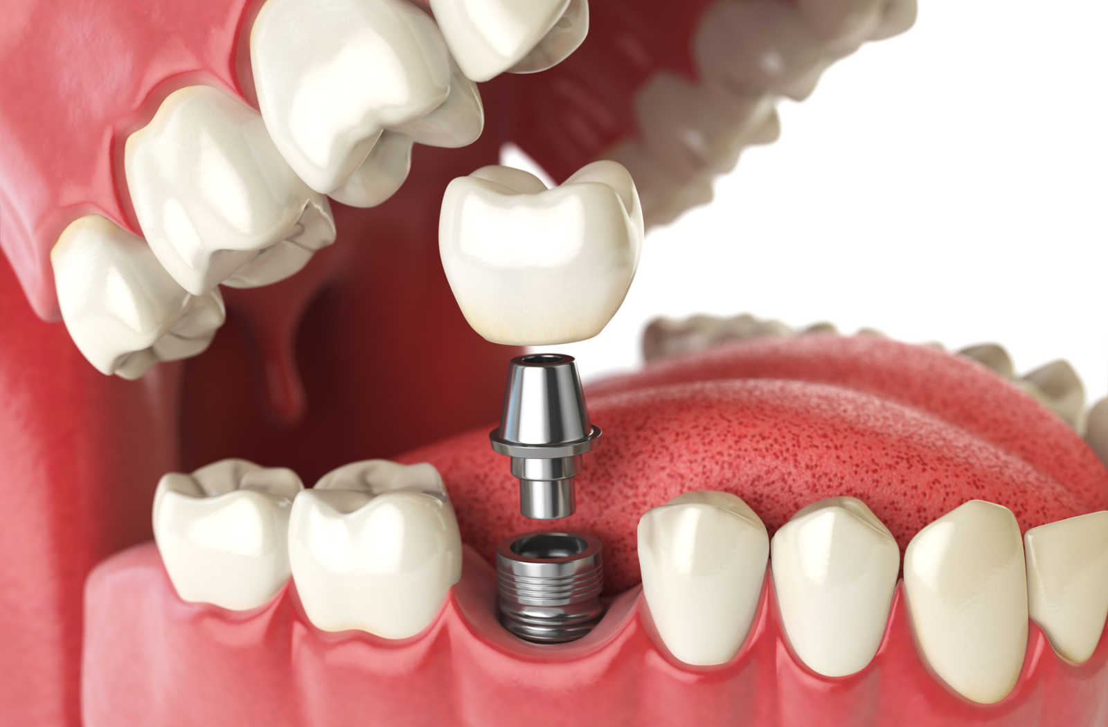 Dental Implants & Crowns