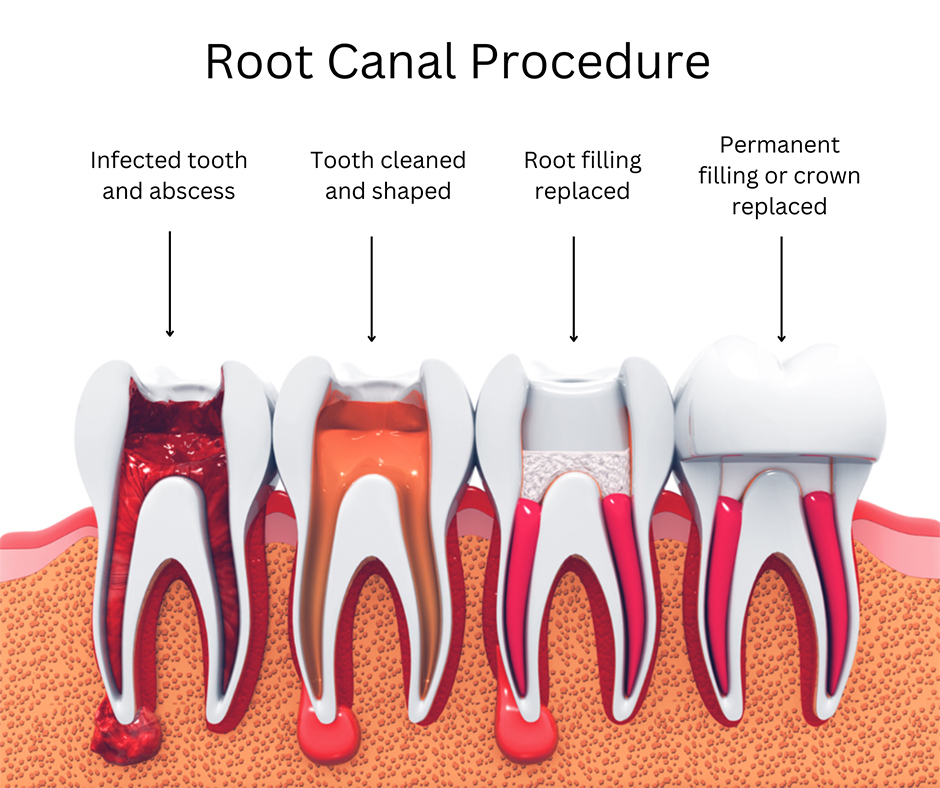 Root Canal Treatment
