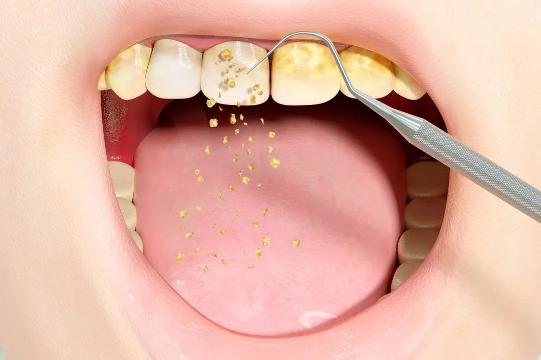 Teeth Cleaning & Whitening